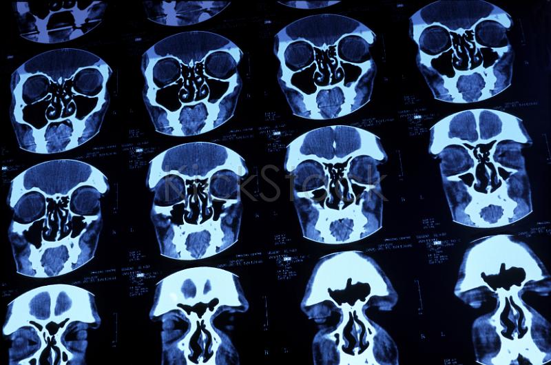 ct scan of a human head